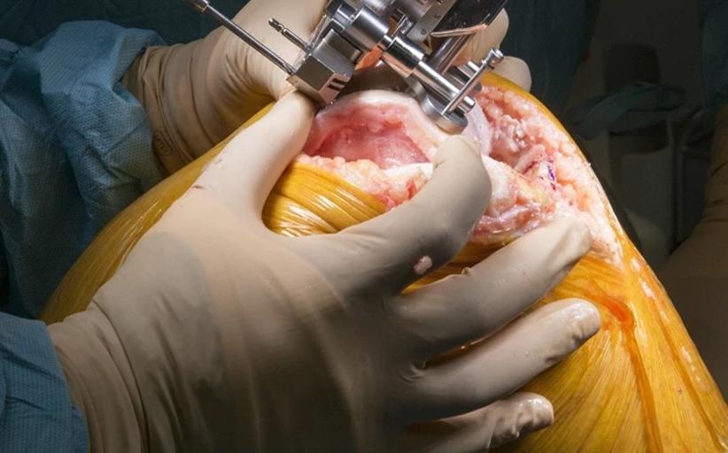 نقطه هدف در جراحی تعویض مفصل زانو